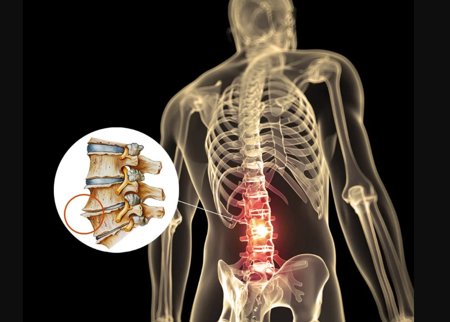 Bico de Papagaio: Exercícios e Cuidados Essenciais bico de papagaio